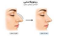 عمل رینوپلاستی 